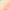 How does stress correlate with facial acne?