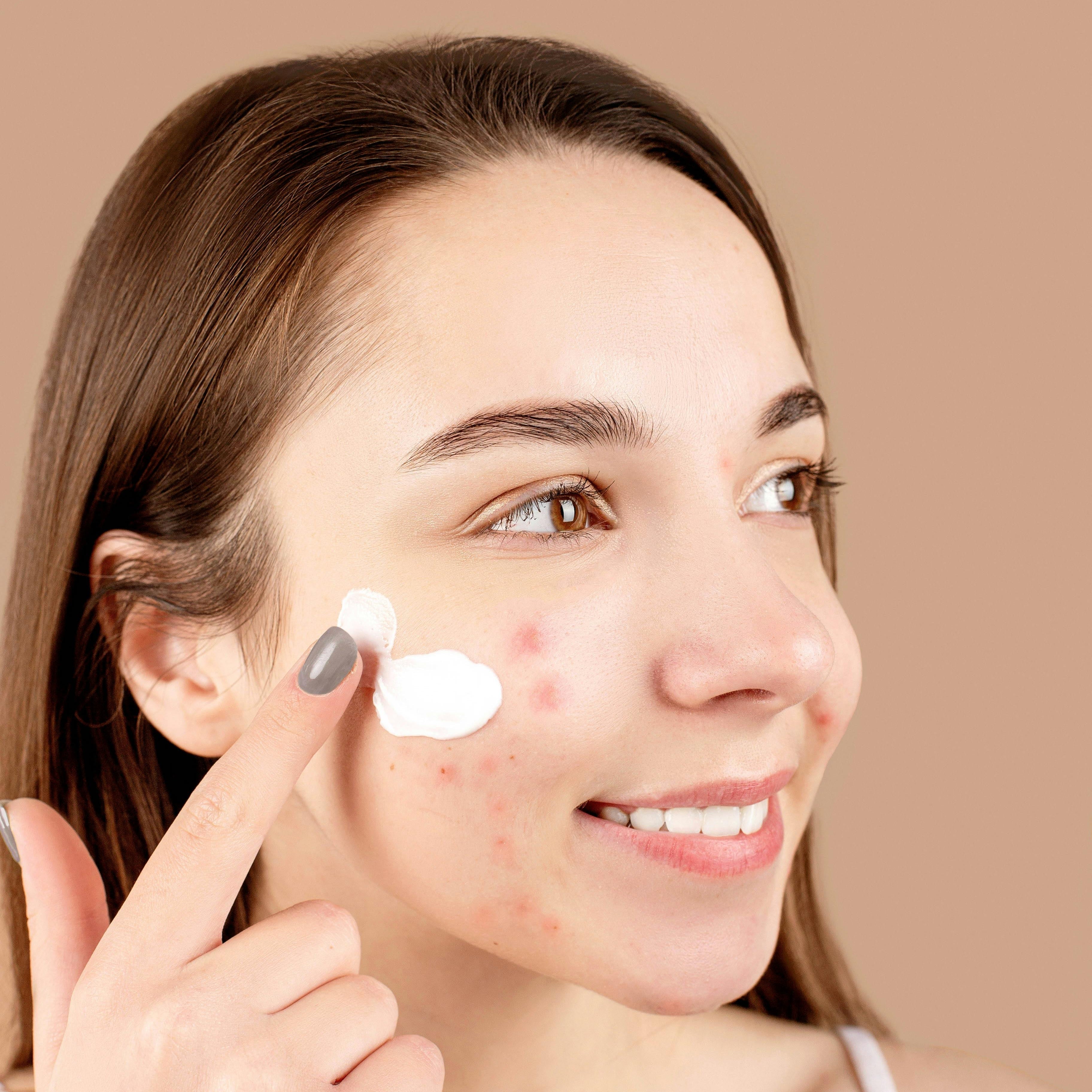 Girl with acne applying cream to cheek.